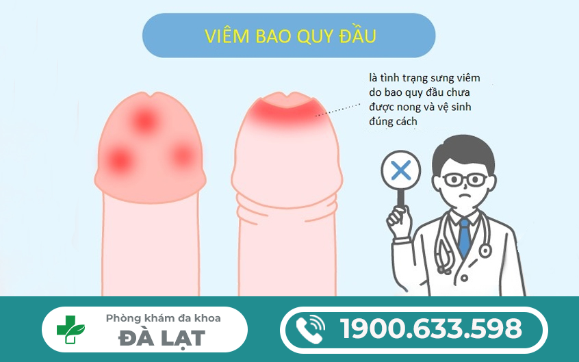 VIÊM BAO QUY ĐẦU CÓ TỰ KHỎI ĐƯỢC KHÔNG, BAO LÂU THÌ KHỎI?
