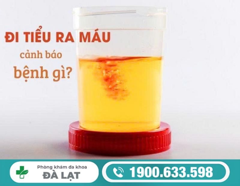 ĐI TIỂU RA MÁU Ở NAM GIỚI: TRIỆU CHỨNG, NGUYÊN NHÂN VÀ CÁCH ĐIỀU TRỊ HIỆU QUẢ