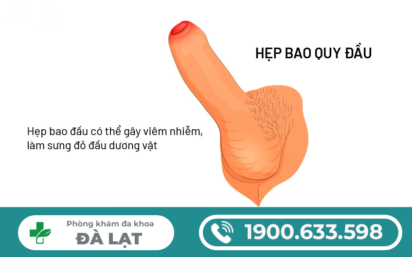 CẮT HẸP BAO QUY ĐẦU Ở ĐÂU UY TÍN NHẤT? ĐỊA CHỈ PHÒNG KHÁM TẠI ĐÀ LẠT!