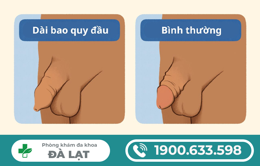 BAO QUY ĐẦU DÀI VÀ HẸP ? PHƯƠNG PHÁP ĐIỀU TRỊ HIỆU QUẢ NHẤT 2025?