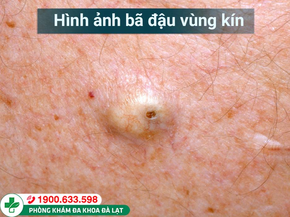 MỤN BÃ ĐẬU Ở VÙNG KÍN? CÁCH CHỮA TRỊ HIỆU QUẢ!