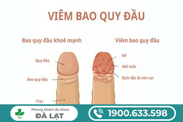   VIÊM BAO QUY ĐẦU LÀ GÌ? NHỮNG ĐIỀU NAM GIỚI CẦN BIẾT 