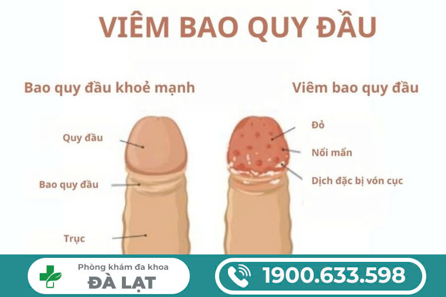 BIỂU HIỆN CỦA VIÊM BAO QUY ĐẦU: CÁCH NHẬN BIẾT CHÍNH XÁC 