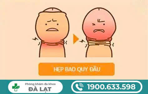 CÁC PHƯƠNG PHÁP ĐIỀU TRỊ HIỆU QUẢ HẸP BAO QUY ĐẦU 