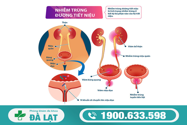 NGUYÊN NHÂN GÂY TIỂU RẮT Ở NAM VÀ NỮ: NHỮNG ĐIỀU BẠN CẦN BIẾT 