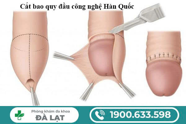 ƯU ĐIỂM VƯỢT TRỘI CỦA PHƯƠNG PHÁP CẮT BAO QUY ĐẦU HÀN QUỐC 