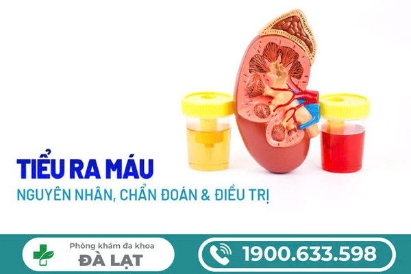 TIỂU RA MÁU: NGUYÊN NHÂN VÀ CÁCH ĐIỀU TRỊ 