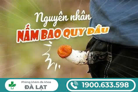 PHƯƠNG PHÁP ĐIỀU TRỊ NẤM BAO QUY ĐẦU Ở NAM GIỚI 