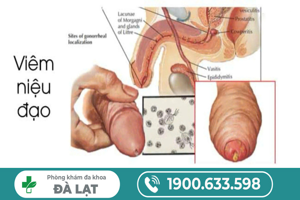 VIÊM NIỆU ĐẠO BAO LÂU THÌ KHỎI? GIẢI ĐÁP CHI TIẾT