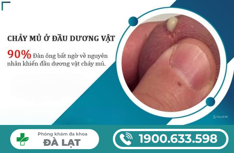 DƯƠNG VẬT CÓ MỦ XANH: NGUYÊN NHÂN VÀ CÁCH ĐIỀU TRỊ