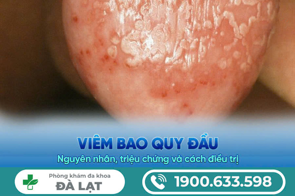 SƯNG BAO QUY ĐẦU: DẤU HIỆU BỆNH LÝ KHÔNG NÊN CHỦ QUAN 