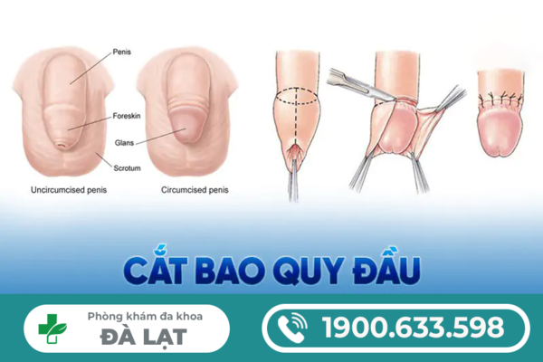 TƯ VẤN CẮT BAO QUY ĐẦU – GIẢI ĐÁP NHỮNG CÂU HỎI NAM GIỚI THƯỜNG GẶP