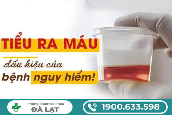 ĐI TIỂU RA MÁU CÓ SAO KHÔNG? GIẢI ĐÁP CỦA BÁC SĨ CHUYÊN KHOA