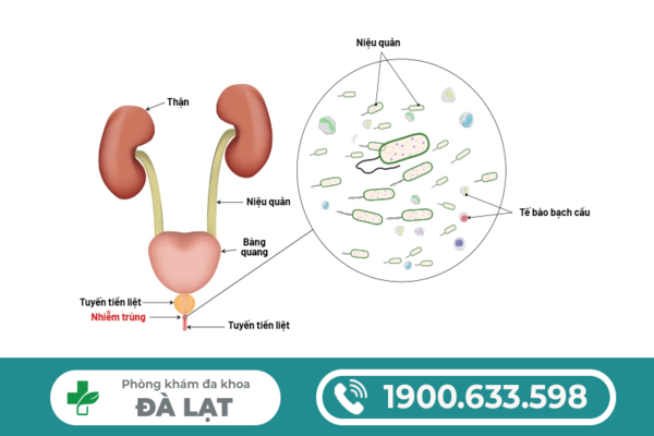 VIÊM NIỆU ĐẠO DO LẬU: NGUYÊN NHÂN, BIẾN CHỨNG VÀ CÁCH ĐIỀU TRỊ