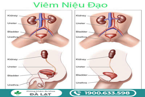 VIÊM NIỆU ĐẠO Ở NỮ GIỚI: TRIỆU CHỨNG, NGUYÊN NHÂN VÀ CÁCH ĐIỀU TRỊ 