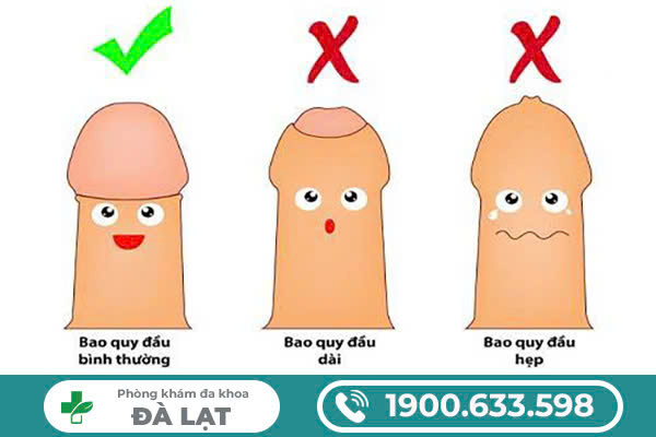 KHẮC PHỤC DÀI BAO QUY ĐẦU: CÁC PHƯƠNG PHÁP AN TOÀN CHO NAM GIỚI