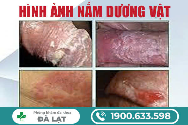 NAM GIỚI BỊ NẤM SINH DỤC NGUYÊN NHÂN DO ĐÂU?