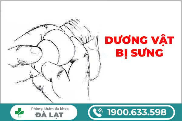 DƯƠNG VẬT BỊ SƯNG VÀ CHẢY MỦ LÀ GÌ? DẤU HIỆU CẢNH BÁO BỆNH LÝ NGUY HIỂM