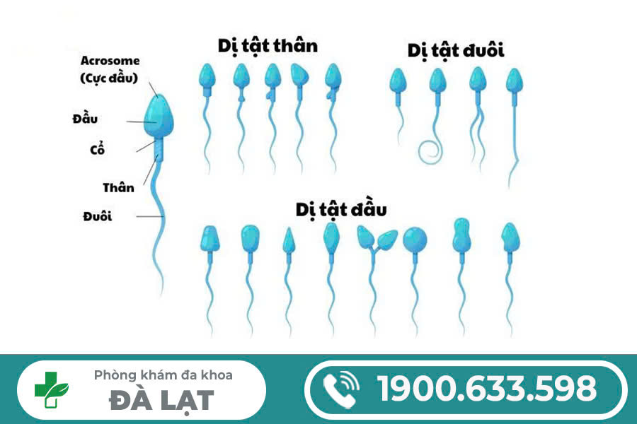 TINH TRÙNG VÓN CỤC CÓ SAO KHÔNG? CÁCH ĐIỀU TRỊ HIỆU QUẢ