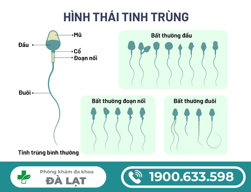 CÁC PHƯƠNG PHÁP ĐIỀU TRỊ TINH TRÙNG LOÃNG HIỆU QUẢ HIỆN NAY 