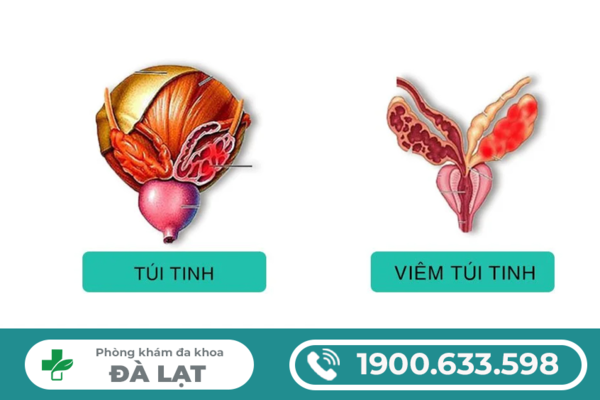 CÁC DẤU HIỆU VIÊM TÚI TINH THƯỜNG GẶP Ở NAM GIỚI