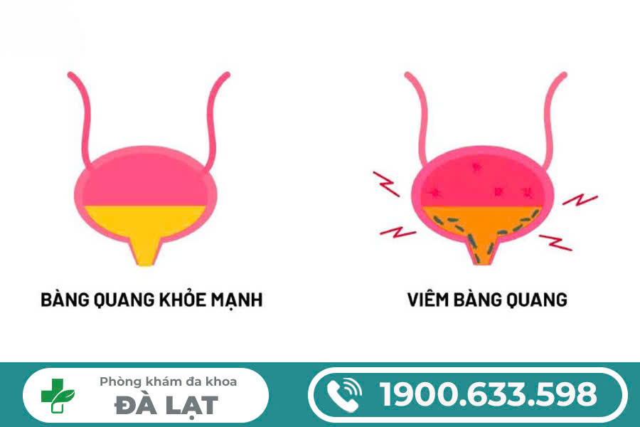 VIÊM BÀNG QUANG CẤP Ở NAM GIỚI: NGUYÊN NHÂN VÀ CÁCH ĐIỀU TRỊ HIỆU QUẢ