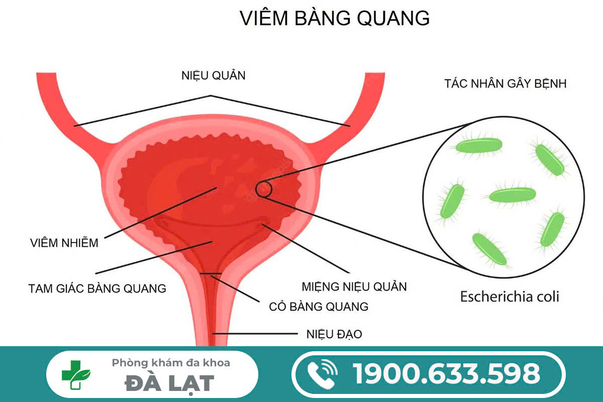 VIÊM BÀNG QUANG CHẢY MÁU Ở NAM GIỚI: NGUYÊN NHÂN VÀ CÁCH ĐIỀU TRỊ HIỆU QUẢ 