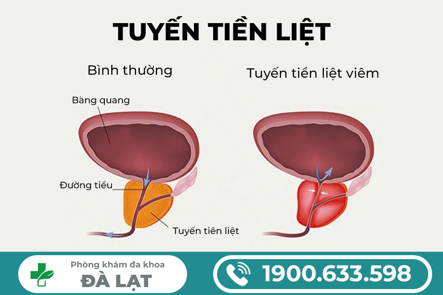 BỆNH VIỆN CHỮA VIÊM TUYẾN TIỀN LIỆT TỐT HIỆN NAY