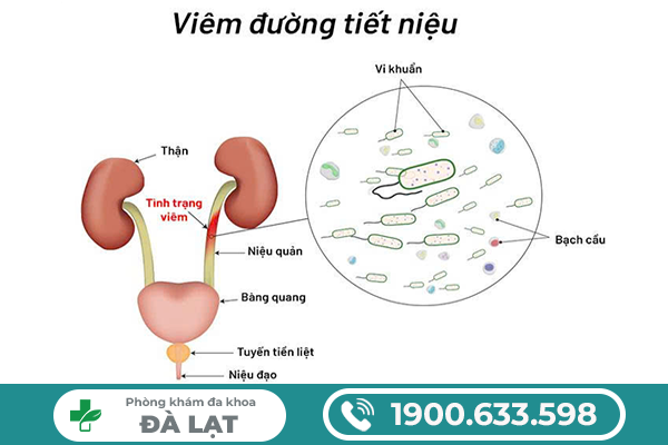 PHƯƠNG PHÁP ĐIỀU TRỊ HIỆU QUẢ VIÊM ĐƯỜNG TIẾT NIỆU Ở NAM GIỚI 