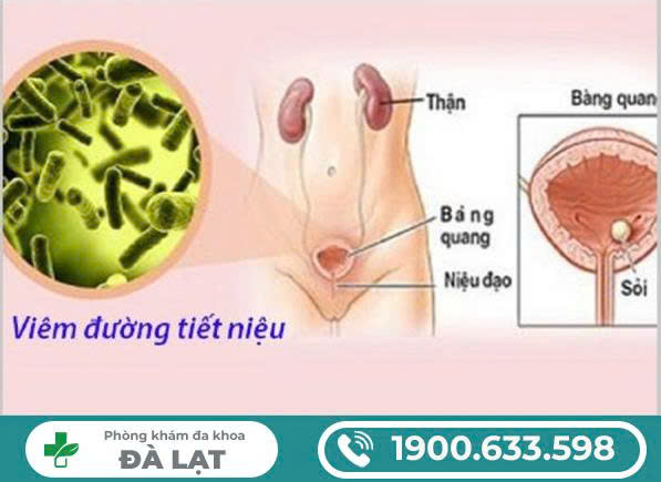 TRIỆU CHỨNG VIÊM ĐƯỜNG TIẾT NIỆU Ở NỮ GIỚI THƯỜNG GẶP