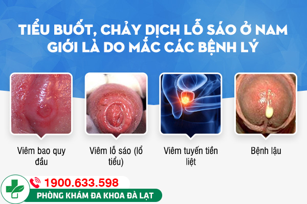 PHƯƠNG PHÁP ĐIỀU TRỊ TIỂU BUỐT Ở NAM GIỚI HIỆU QUẢ HIỆN NAY 