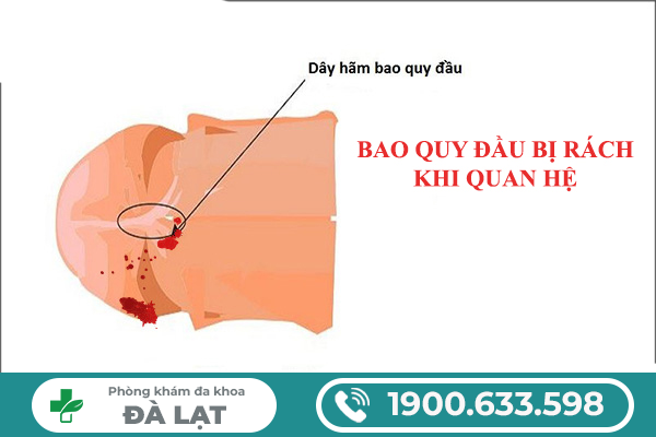 NAM GIỚI BỊ RÁCH BAO QUY ĐẦU SAU KHI QUAN HỆ: NGUYÊN NHÂN VÀ CÁCH ĐIỀU TRỊ