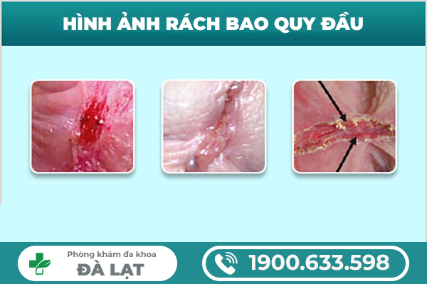 PHƯƠNG PHÁP ĐIỀU TRỊ RÁCH BAO QUY ĐẦU HIỆU QUẢ HIỆN NAY