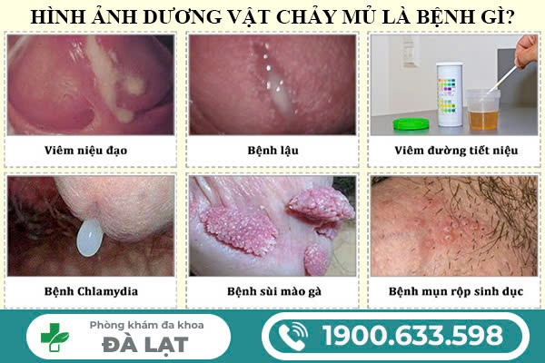 NAM GIỚI BỊ ĐAU LỖ SÁO: NGUYÊN NHÂN, DẤU HIỆU VÀ CÁCH ĐIỀU TRỊ HIỆU QUẢ