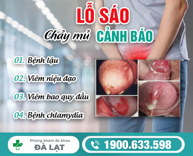 LỖ SÁO CHẢY MỦ LÀ BỆNH GÌ? CẢNH BÁO VẤN ĐỀ NGUY HIỂM Ở NAM GIỚI 