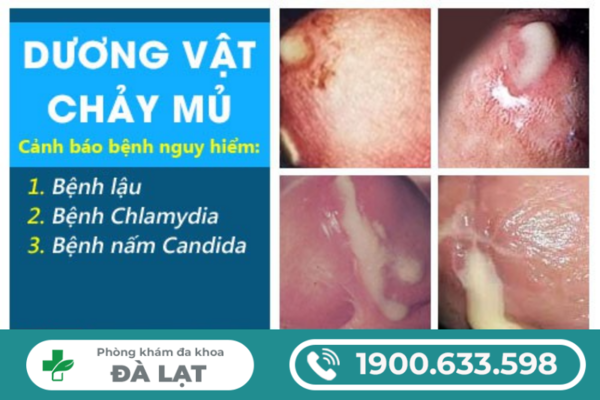 NAM GIỚI BỊ MỌC MỤN Ở LỖ SÁO: ĐỪNG CHỦ QUAN VỚI DẤU HIỆU BẤT THƯỜNG NÀY