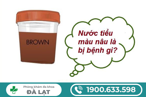 ĐI TIỂU CÓ MÀU NÂU LÀ BỆNH GÌ? CẢNH BÁO BIẾN CHỨNG NGUY HIỂM Ở NAM VÀ NỮ