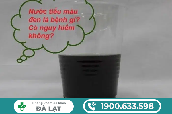 NƯỚC TIỂU CÓ MÀU ĐEN LÀ BỆNH GÌ? CẢNH BÁO BỆNH NGUY HIỂM Ở NAM VÀ NỮ