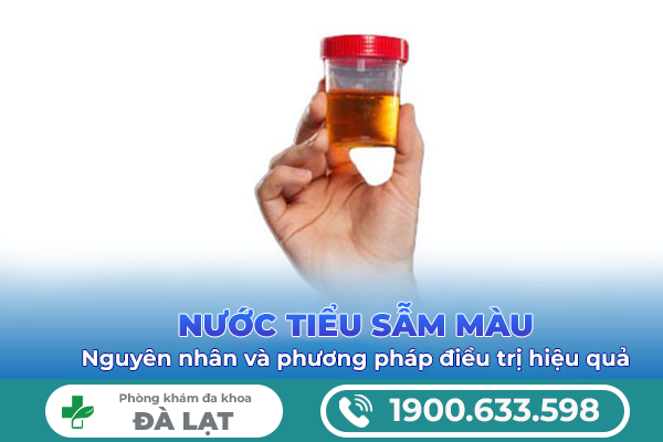 NƯỚC TIỂU SẪM MÀU Ở NAM VÀ NỮ LÀ BỆNH GÌ? BÁC SĨ GIẢI ĐÁP CHI TIẾT