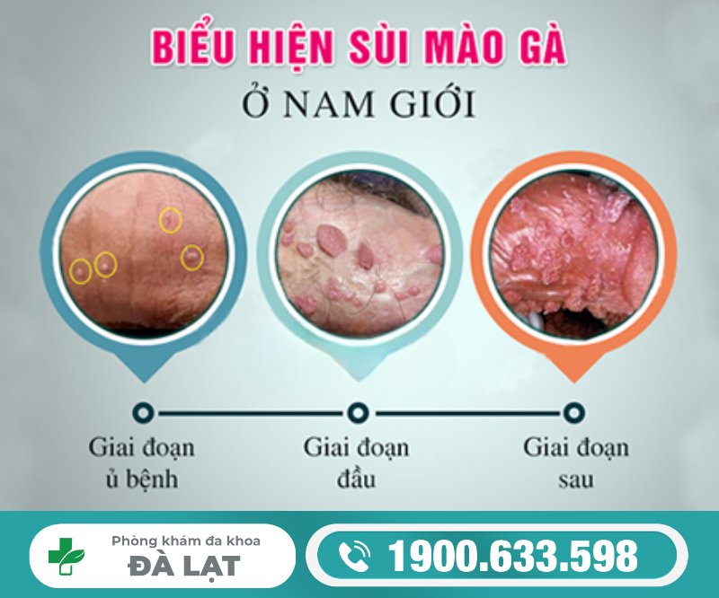 NAM GIỚI BỊ SÙI MÀO GÀ Ở ĐẦU KHẤC: DẤU HIỆU NHẬN BIẾT KHÔNG NÊN BỎ QUA