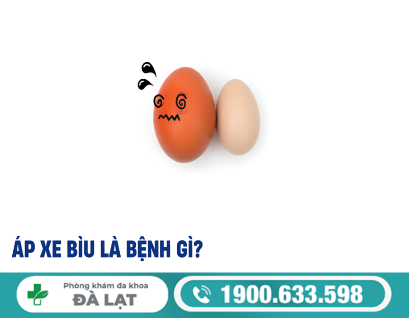 ÁP XE BÌU Ở NAM GIỚI: DẤU HIỆU NHẬN BIẾT SỚM VÀ CÁCH ĐIỀU TRỊ