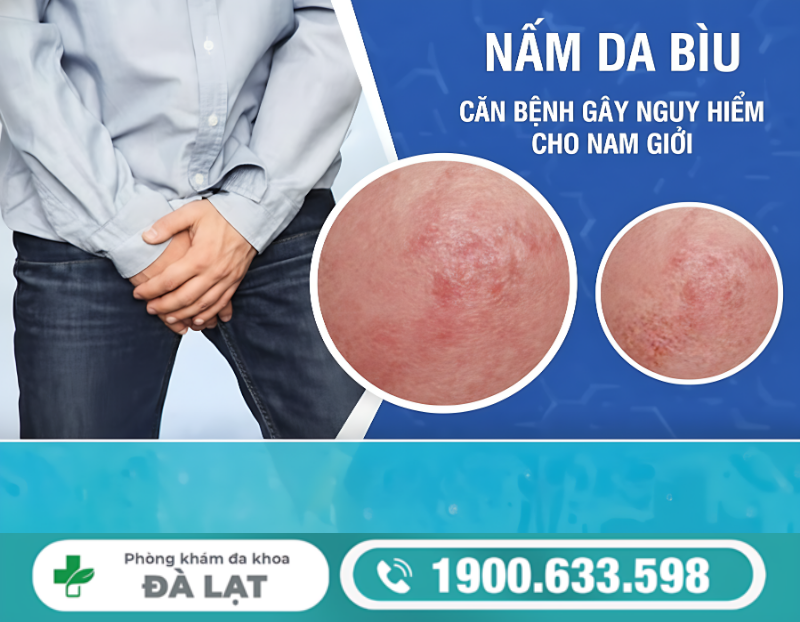 BỆNH NẤM BÌU Ở NAM GIỚI: TRIỆU CHỨNG, NGUYÊN NHÂN VÀ CÁCH ĐIỀU TRỊ